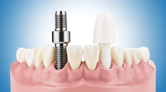 Comparaison visuelle entre implants dentaires en titane et céramique dans un environnement médical moderne