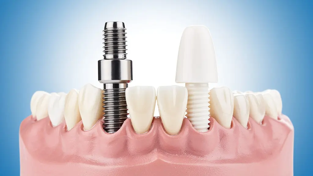 Comparaison visuelle entre implants dentaires en titane et céramique dans un environnement médical moderne
